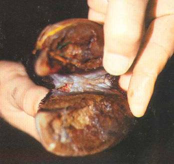 ?ap hastal???nda t?rnaklar?n grnm